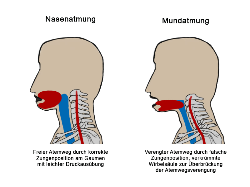Vergleich Nasenatmung und Mundatmung: freier Atemweg durch korrekte Zungenposition am Gaumen gegenüber verengtem Atemweg bei falscher Zungenposition